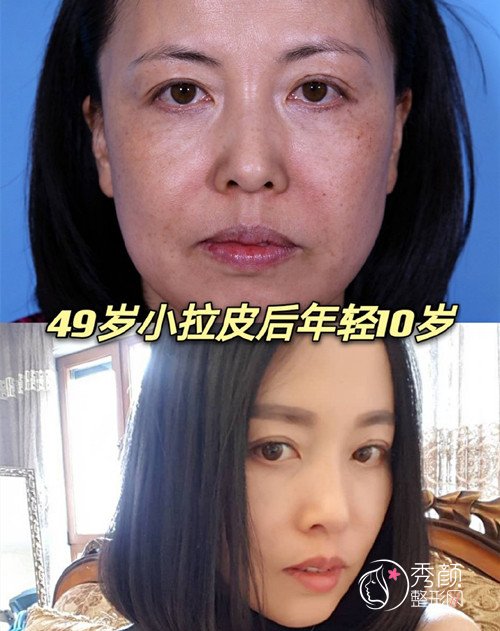 北京加减美v美减龄和东方瑞丽pst面部提升,哪个除皱果比较好