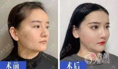 <b>武汉磨骨（颧骨内推）付国友、赵贵庆和吴中兴哪个好?</b>