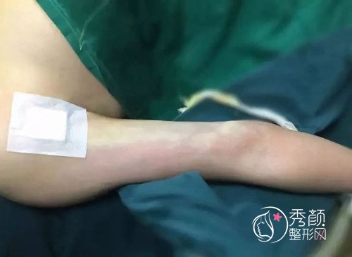 上海九院手臂抽脂案例