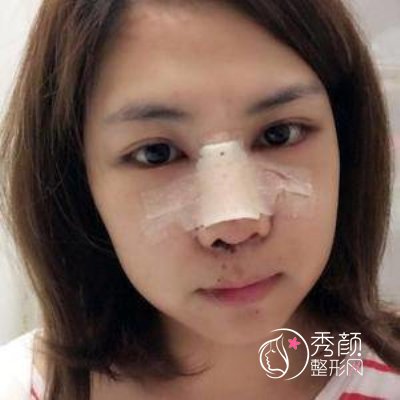 武汉同济医院曾宁鼻部手术怎么样|附隆鼻案例