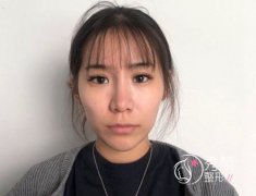 <b>终于在北京做了自体脂肪填充全脸,心里美滋滋。</b>