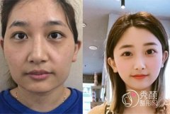 <b>武汉中翰整形吴中兴教授磨骨改脸型怎么样,有没有失败案例?</b>