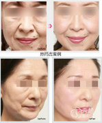 <b>济南伊美尔热玛吉怎么样|价格表</b>