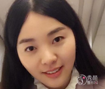 <b>终于我去北京八大处做了鼻部手术+双眼皮修复手术</b>