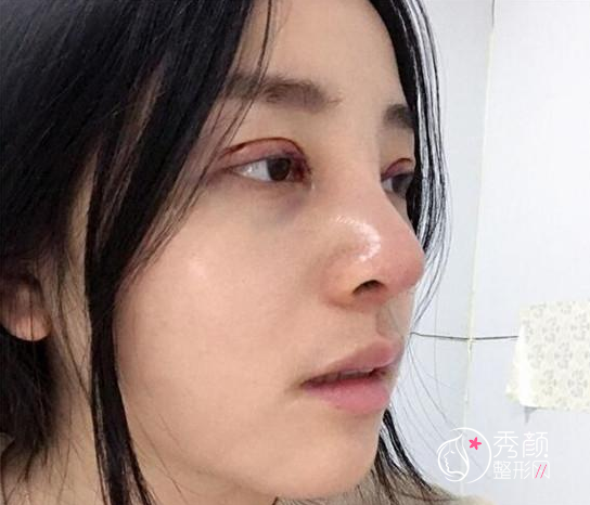 终于我去北京八大处做了鼻部手术+双眼皮修复手术
