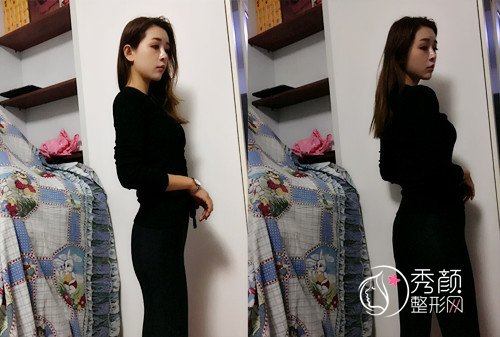 北京华韩余恩旭假体+脂肪丰臀,我也有蜜桃臀啦!