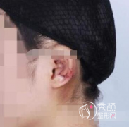 北京八大处耳朵整形多少钱,北京八大处耳朵整形案例