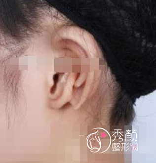 北京八大处耳朵整形多少钱,北京八大处耳朵整形案例