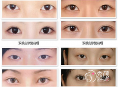 <b>成都双眼皮修复哪个医生好?双眼皮失败修复价格</b>