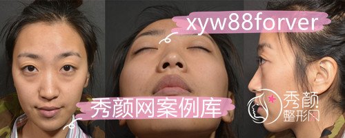 北京柏丽李劲良鼻综合+脂肪填充手术案例