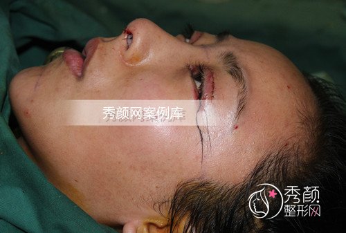 北京柏丽李劲良鼻部手术+脂肪填充手术案例