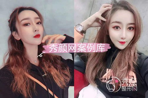 北京柏丽李劲良鼻部手术+脂肪填充手术案例