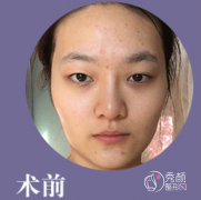 <b>上海生命树徐晓静做双眼皮怎么样,有没有失败案例?</b>