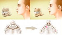 <b>正颌前一定要正畸吗？正颌手术费用一般是多少钱</b>