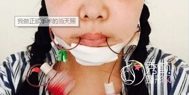 找广州广大医院的何锦泉做了正颌手术很满意。