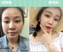 <b>广州南方医院杜本军磨骨怎么样,贵不贵,有没有失败案例?</b>