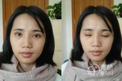 <b>王振军双眼皮修复怎么样,分享王振军给我修复的双眼皮,朋友都说很好</b>