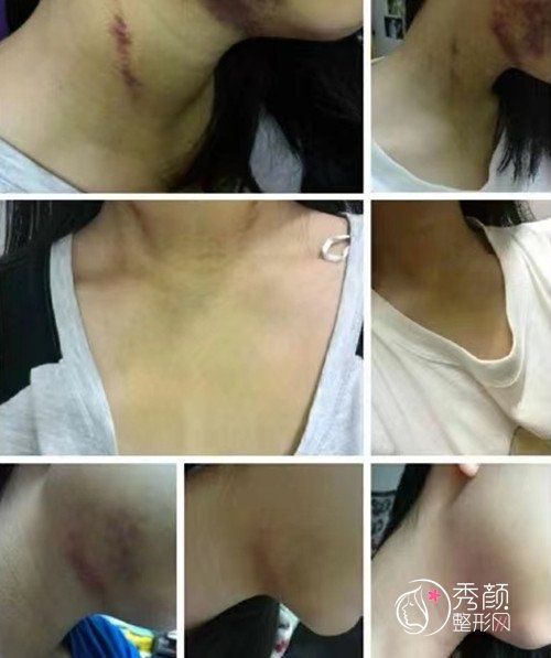 在上海花了差不多10万元做了地包天正颌正畸手术。