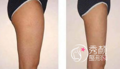 <b>北京东方和谐冯斌吸脂技术怎么样,有没有失败案例,贵不贵?</b>