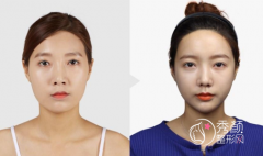 <b>【颌面整形】磨骨手术干货分享，磨骨前必看</b>