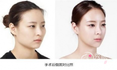 <b>磨骨改脸型大概需要多少钱</b>