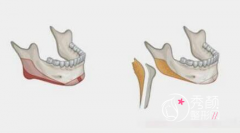 削下颌骨多少钱？方脸磨骨大概需要多少钱