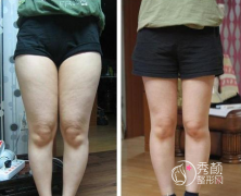 <b>上海九院大腿抽脂怎么样,多久可以运动？</b>