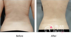 <b>上海九院背部吸脂果怎么样</b>