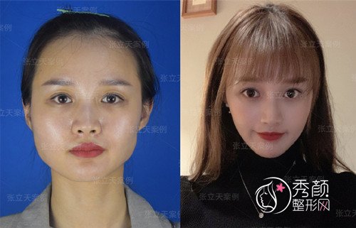 国内有名的磨骨医生四川友谊张立天和上海时光何晋龙哪个磨骨技术好