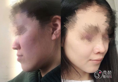 <b>正颌手术费用一般是多少钱?</b>