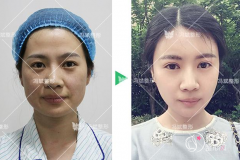 <b>冯斌吸脂为什么那么贵?冯斌吸脂有失败案例吗?</b>