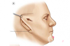 <b>拉皮手术大概需要多少钱?大拉皮和小拉皮手术有什么区别?</b>