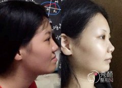 我的正颌手术日记：上海九院王旭东做的双颌手术