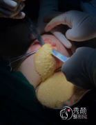 <b>奥美定取出一般需要多少钱?</b>