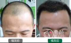 国内知名的植发医院有哪些,植发多少钱?