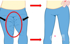 <b>上海九院曹卫刚吸脂怎么样,有没有失败案例?</b>