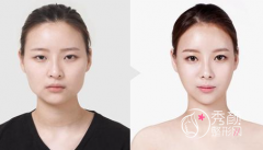 <b>磨骨是选国内医院好还是韩国医院好?</b>