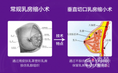 <b>杭州美莱栗勇做巨乳缩小手术真的好吗,缩胸术前术后图片对比。</b>