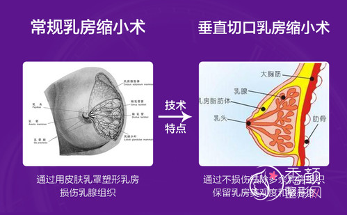 杭州栗勇做巨乳缩小手术真的好吗|附缩胸术前术后图片对比。