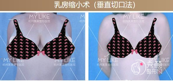 杭州美莱栗勇做巨乳缩小手术真的好吗,缩胸术前术后图片对比。
