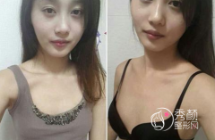 <b>上海九院隆胸技术怎么样,靠谱吗,大概需要多少钱?</b>