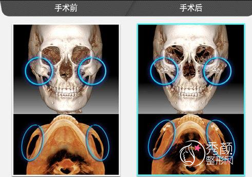 颧骨整形多少钱？脸部不对称颧骨一高一低怎么矫正？