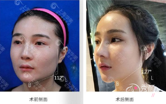 李志海磨骨怎么样,李志海磨骨有失败案例吗