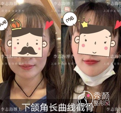 上海华美李志海磨骨改脸型怎么样,大概需要多少钱?