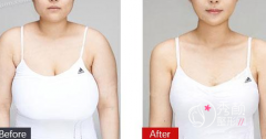 <b>西安西京医院缩胸手术多少钱?</b>