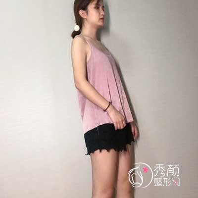 广州军美王世虎吸脂怎么样,有没有失败案例