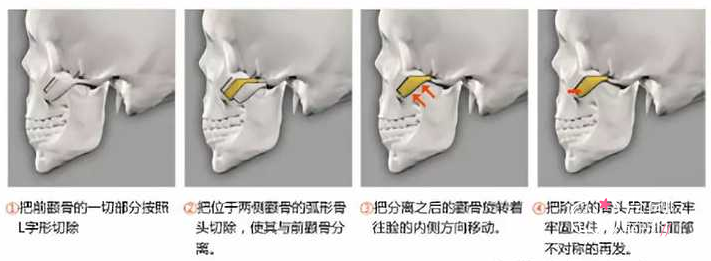 河南中医药大学一附院颧骨内推怎么样,大概需要多少钱?