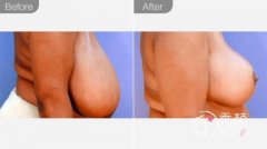 <b>北京八大处穆大力缩胸技术怎么样</b>