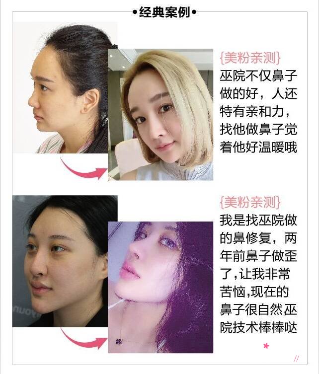 北京鼻部整形大咖：薛志强和巫文云哪个好