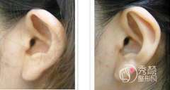 招风耳矫正整形一般多少钱,有没有风险,有没有后遗症